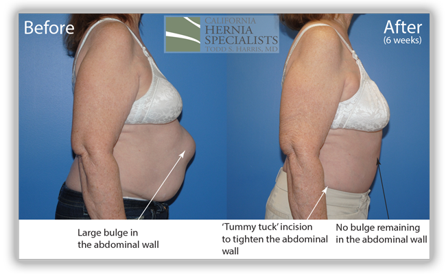 Ventral Hernia Repair Before and After Pictures
